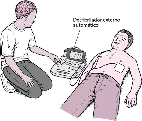 Los desfibriladores pueden ser utilizados en adultos. Figure: Desfibrilador externo automático: poner en marcha ...