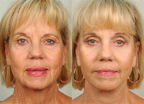 Facelift & Necklift Before & After Photos | Dr. Yarish ...