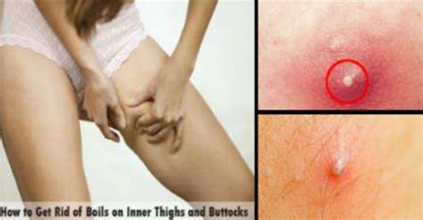 Laser hair removal is best for butt hair. How To Get Rid Of Boils On Inner Thighs And Buttocks