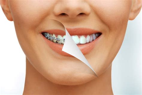 What's the fastest way to straighten your teeth? How to Straighten Teeth Without Braces | ALIGNERCO