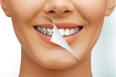 Braces are the most common treatment for teeth straightening, whether metal or ceramic brackets fixed to the teeth, or clear aligners that straighten teeth without it being so obvious. How to Straighten Teeth Without Braces | ALIGNERCO