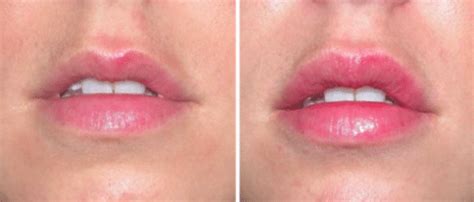 Add definition to your lips with our effective treatments! | Sobel Skin