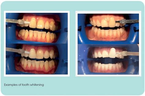 Professional teeth whitening can be an ideal solution for many patients who are looking to remove yellow stains. How To Remove Chlorhexidine Stains From Teeth - TeethWalls