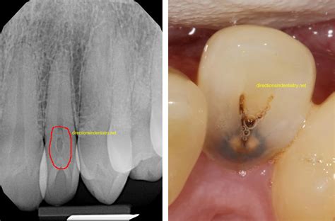 Dens in Dente of Incisor Tooth | Photos and Pictures Dens Invaginatus