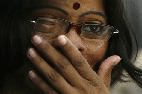Acid Attack on Delhi Doctor: Rejected Suitor Committed the Crime, say ...