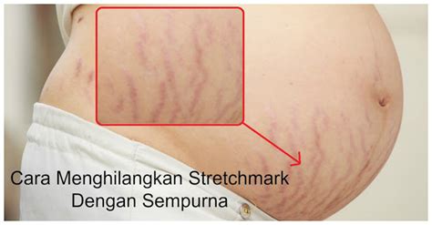 Namun, bumil tidak perlu khawatir, karena ada beberapa cara yang dapat dilakukan untuk menyamarkan stretch mark yang muncul. Bekas Stretchmark Setelah Melahirkan ini Ternyata Bisa di ...