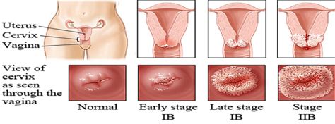 Even if cervical hpv infection is incredibly common, cervical cancer is relatively rare. Cervical cancer | UK| PDF | PPT| Case Reports | Symptoms ...