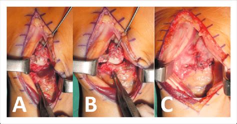 Total wrist arthroplasty froschauer sm, holzbauer m, hager d, kwasny o, duscher d. Intraoperative demonstration of the proximal row ...