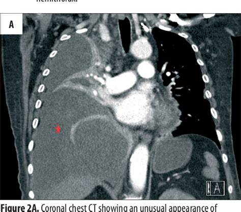 Liquid or other matter poured forth. Figure 2 from Multiloculated pleural effusion detected by ...