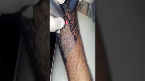 Looking for laser tattoo removal in houston, tx? Pin on Laser Tattoo Removal Houston, TX