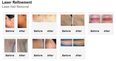 To remove a visible part of hair (depilation) business troublesome, since. Beverly Hills Laser Hair Removal Before After Photos | Dr ...