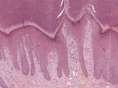 Clínica:prurido noturno intenso sulco < 1. dermatopatologia para iniciantes: 16) QUAL O SEU DIAGNÓSTICO?