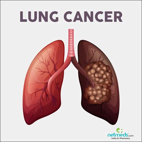 Lung cancer is the leading cause of cancer death in the united states. Lung Cancer: Causes, Symptoms And Treatment | Netmeds