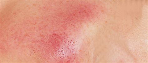 Jag är rätt säker på att mina utslag är någon form av ros och ska till vårdcentralen nu i eftermiddag för att få dem undersökta. Symptom på rosacea - Rosacea.se