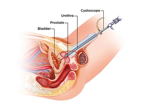 Sistem urinaria adalah suatu sistem. An Overview of Cystoscopy | Urology Specialist Sydney