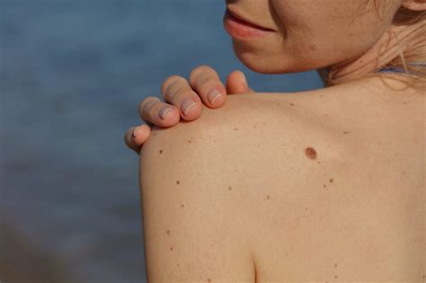 If you see any suspicious skin lesion, especially one that is new or changed in size, contact your doctor. Melanoma: What You Need to Know About Diagnosis and Treatment