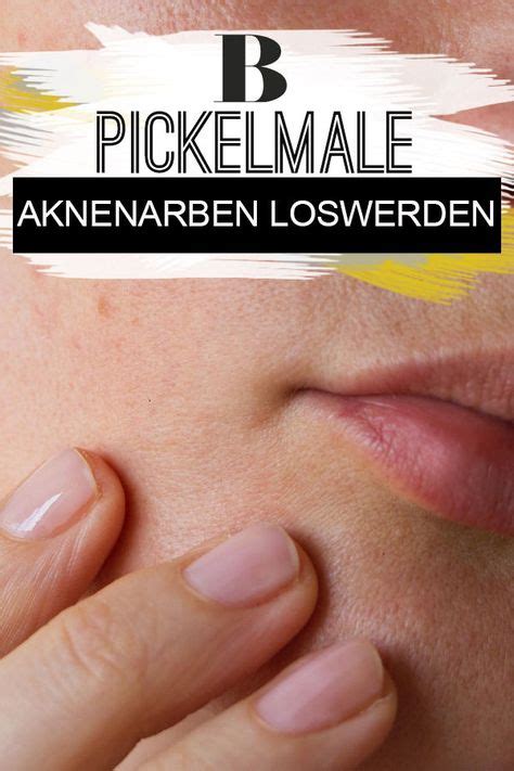 Hausmittel gegen pickelmale entfernen pickelnarben durch bleichen der haut im gesicht. Pickelmale - so werdet ihr Aknenarben los! | Aknenarben ...