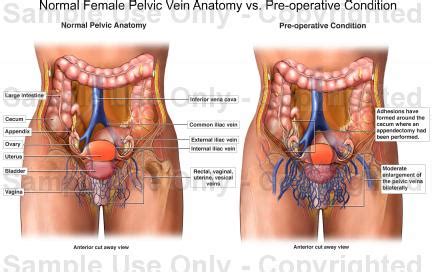 It is a type of rare abdominal wall defect characterized by a protrusion in the abdominal wall that comprises preperitoneal fat, omentum, or an organ. Normal Female Pelvic Vein Anatomy vs. Pre-operative ...