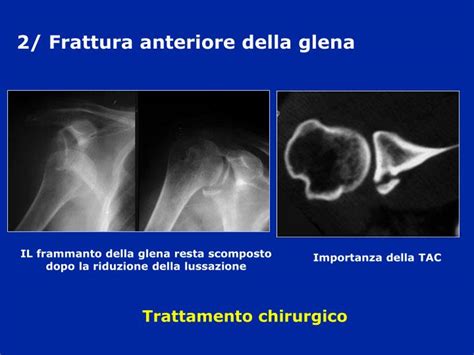 PPT - Lussazioni di spalla PowerPoint Presentation - ID ...