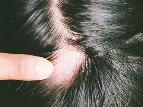 Alopecia areata may be hereditary and isn't contagious. New guidelines create a 'paradigm shift' in alopecia | Australian Doctor Group