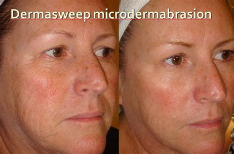 How does uneven skin texture feel like? Microdermabrasion - LaVida MedSpa