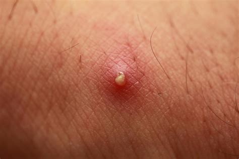 Get rid of a boil fast. Boil vs. pimple: How to tell the difference