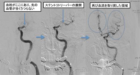 Aeroembolism, air embolism, bends, caisson disease, decompression sickness, gas embolism. 脳梗塞超急性期治療｜秋山脳神経外科病院