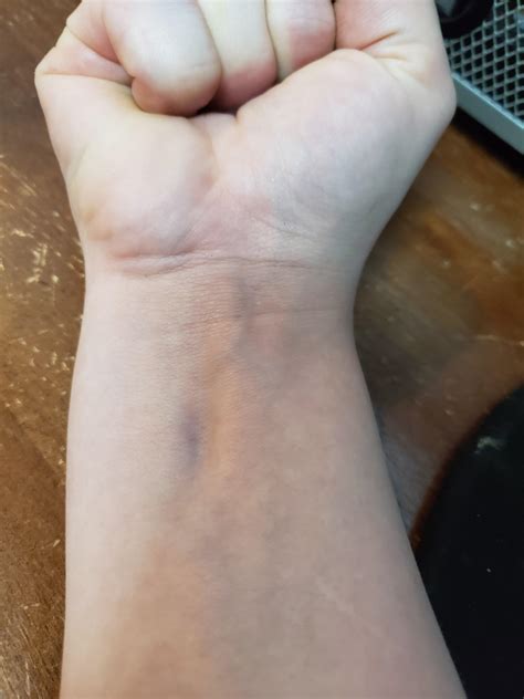 Does anyone know what is happening to my wrist?? It hasnt 