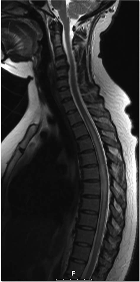 Transverse myelitis is a rare neurological syndrome that causes inflammation on both sides of the spinal cord, resulting from damage to nerve cells. Longitudinally extensive transverse myelitis: a rare ...