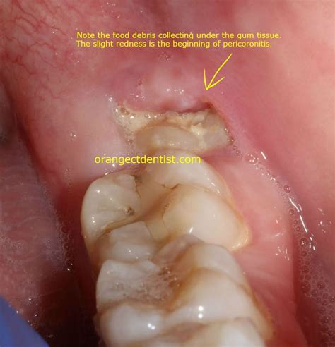 According to a report published in the american journal of public health, more than 67 % of preventative wisdom teeth removals are unnecessary. 35 best Wisdom Teeth images on Pinterest | Wisdom tooth ...