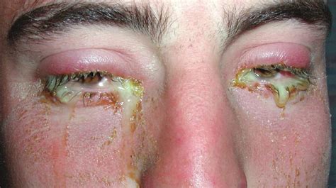 Die virale bindehautentzündung ist eine weitere häufige form, die höchst ansteckend ist, da durch die luft übertragene viren durch. Study Medical Photos: Bacterial Conjunctivitis - A Brief ...