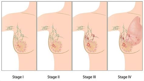 Breast cancer symptoms and precautions in hindi. The Stages of Breast Cancer: What You Need to Know ...