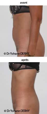 Tot ce trebuie să știți despre abdominoplastie. Photos abdominoplastie ,photos plastie abdominale, mini ...
