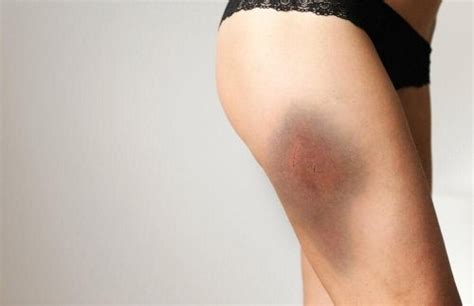 Some people even harm themselves by punching themselves with enough force. 5 Natural Solutions to Treat Bruises - Step To Health