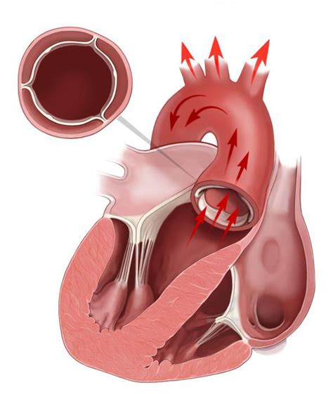 Stricture as a term is usually used when narrowing is caused by contraction of smooth muscle (e.g. Stenosi mitralica: cause, sintomi, trattamento