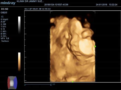 Saja nak berkongsi pengalaman anak kedua saya hayfa rania pada 2 minggu lepas. Farah Shahirah: Pengalaman Scan 2D/3D/4D *First Baby