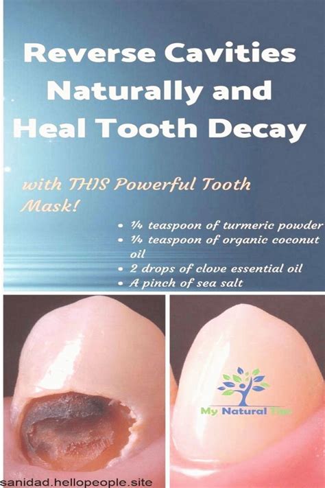 But after knowing that now you can reverse tooth decay by replenishing the enamel, the first question that pops up in your mind is 'how to reverse the tooth. How To Heal Tooth Decay And Reverse Cavities Naturally in ...