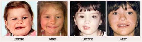 Bell's palsy is rarely considered to be a serious illness as patients nearly always recover on their own, without needing treatment. Facial Paralysis And Bell's Palsy Surgery Specialist ...