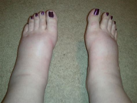 Swollen ankles, feet and legs are common among travelers—especially older ones. From Infertile to a Family...: 40 Weeks, Due Date, Swollen ...