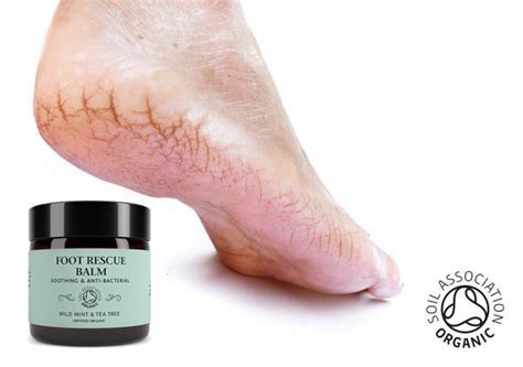 Get The Best Natural Balm For Cracked Heels Itchy Feet And ...