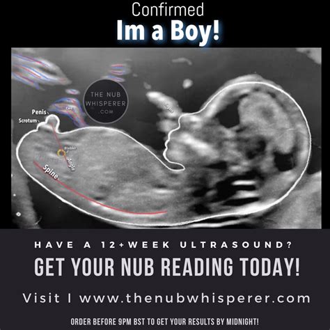 Predictions made by sonographers during routine obstetric ultrasound. Get yours today! Within 24hrs max! | Gender prediction ...
