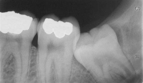Kemudian tempek dekat gigi/gusi yang sakit tadi. Cara Menghilangkan Rasa Sakit Gigi Geraham Bawah ...