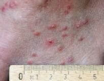 Wenn sie diese symptome nach dem baden an sich beobachten, könnten zerkarien die ursache sein. Blog der Rebland-Apotheke: "Parasiten": Teil 5: Zerkarien