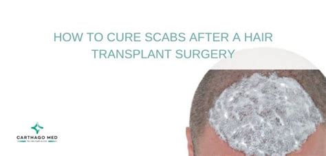 You can wash your hair 72 hours after the surgery as it helps in removing these scabs. How to cure scabs after a hair transplant surgery ...