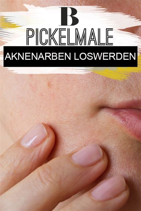 A variant of bickel 1. Pickelmale - so werdet ihr Aknenarben los! | Aknenarben ...