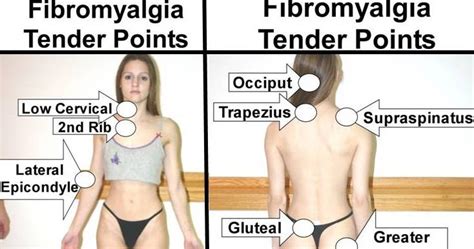 Zusammenfassende übersicht aus und zu publikationen aus der schmerz (2008) 22: Survivor: Wordless Wednesday: Fibromyalgia Tender Points