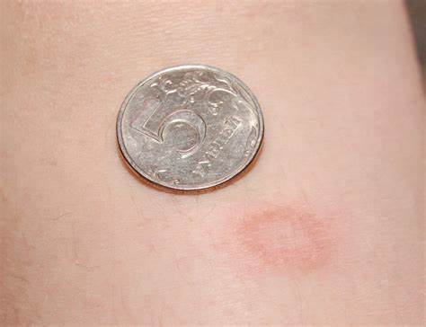 Дерматит симптомы диета Нуммулярный дерматит, монетовидная экзема у детей и взрослых: симптомы Нуммулярный дерматит, монетовидная экзема у детей и взрослых: симптомы Дерматит симптомы диета