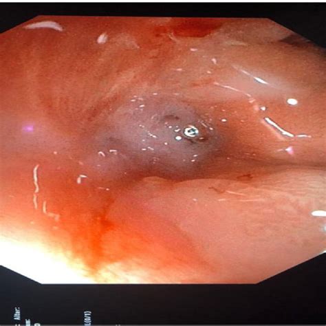 Fistulas may develop between different organs, such as between the esophagus and the windpipe or the bowel and the vagina. A 26-year-old male patient presented with tachycardia ...