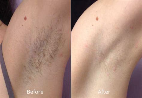 Guide to full body+face hair removal | faq. Laser Hair Removal at Chesapeake Medspa in Virginia