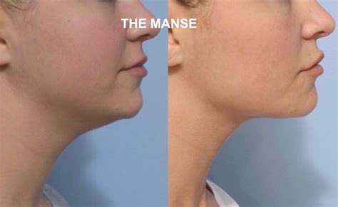 It reduces unflattering and stubborn areas of fat and cellulite without the need for liposuction or surgery. How to Get a Perfect Jawline - Best Clinic Sydney for ...